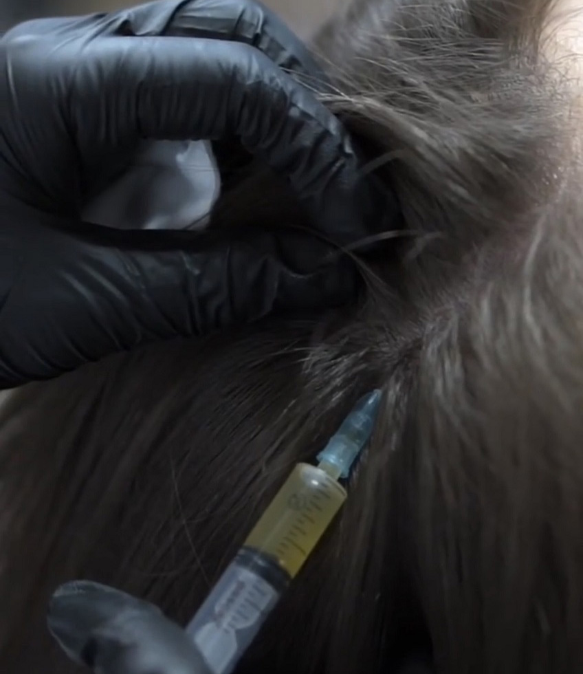 Каким бывает выпадение волос?