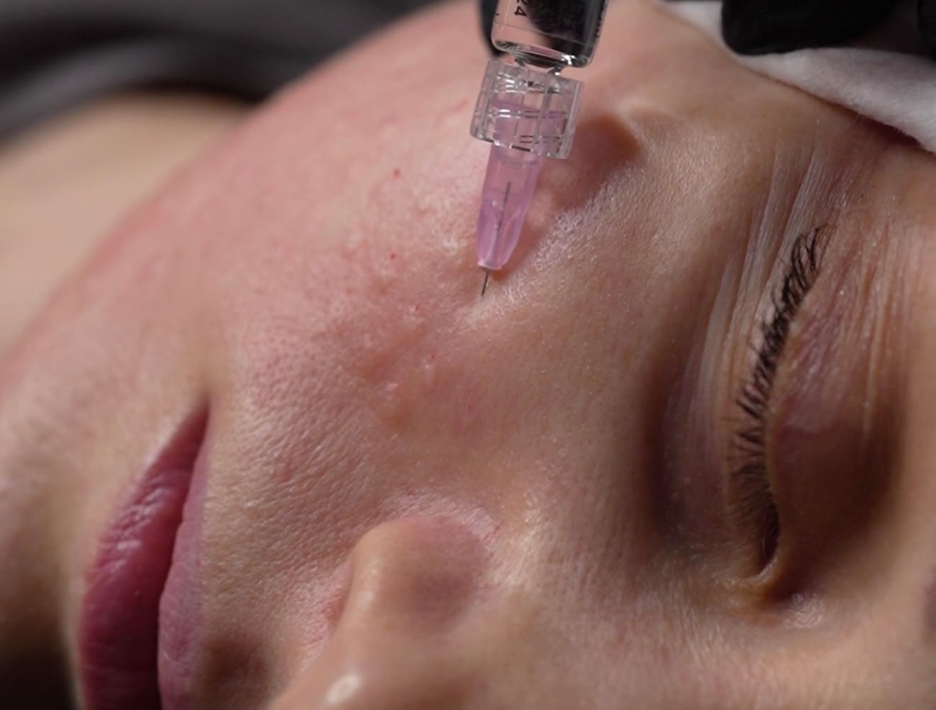 Что нельзя делать после мезотерапии лица