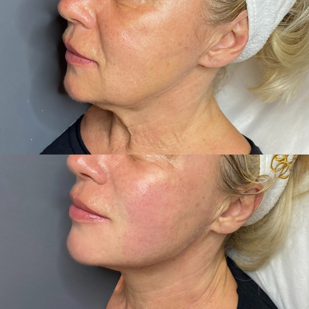 До и после: smas-лифтинг ultraformer фото 12