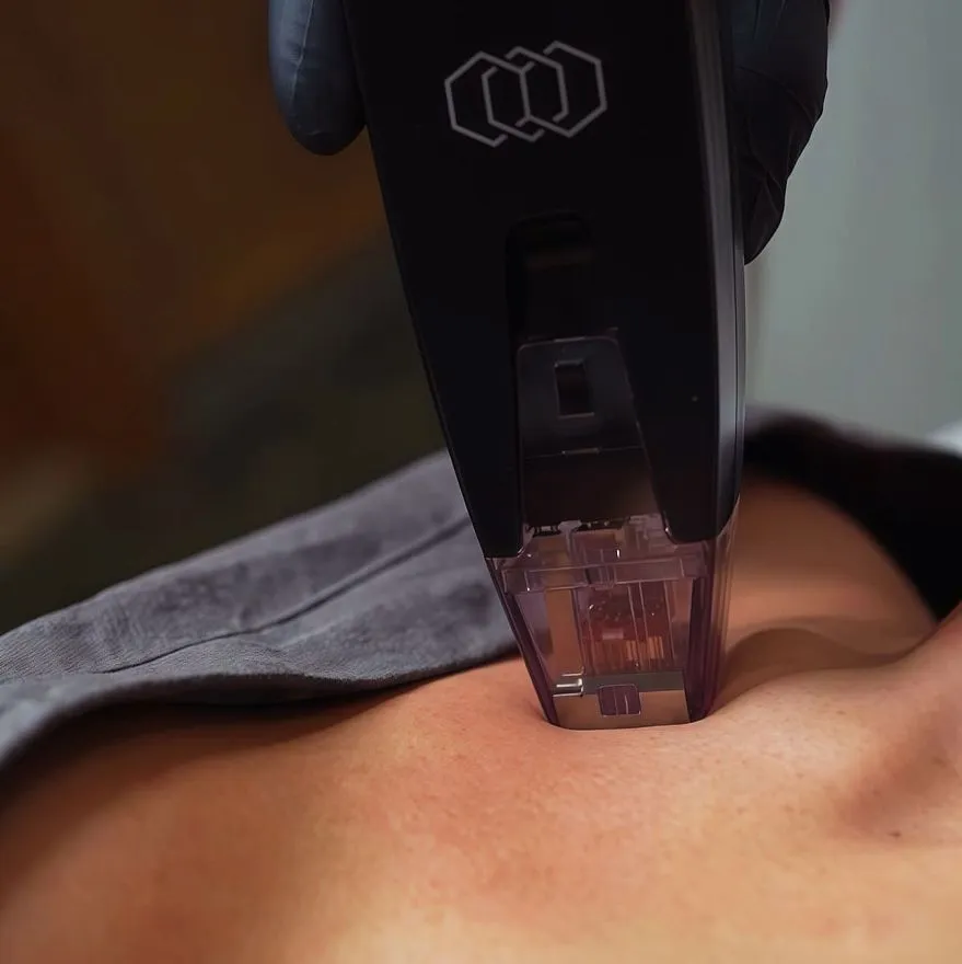 Услуги: morpheus 8 (rf-лифтинг)