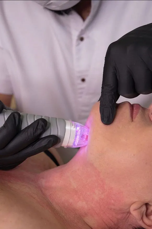 Услуги: vivace virtue (rf-лифтинг)