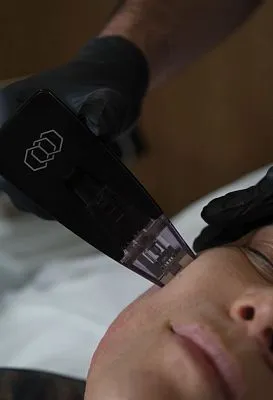 Как избавиться от носогубных складок без пластической операции