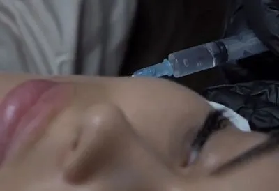 Коллагеновые инъекции: что происходит с кожей после процедуры на самом деле